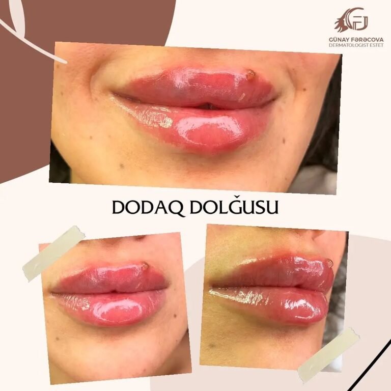 dodaq dolğusu proseduru
