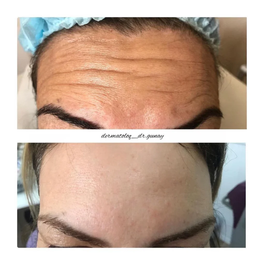 alın botoksu dermatoloq dr gunay